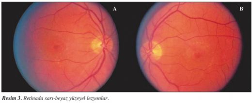 Alport Sendromu Belirtileri ve Tedavisi