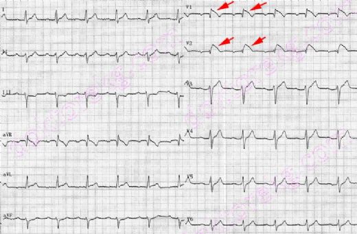 Brugada Sendromu Belirtileri ve Tedavisi