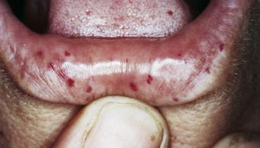 Crest Sendromu Belirtileri ve Tedavisi