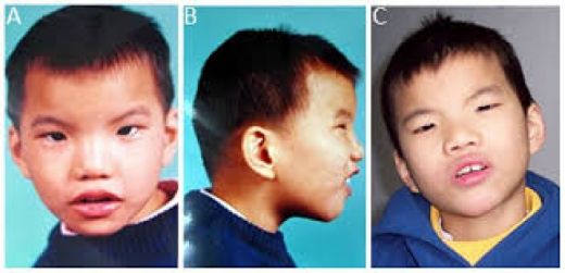 Cri Du Chat Sendromu Belirtileri ve Tedavisi