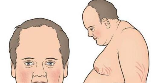 Cushing Sendromu Belirtileri ve Tedavisi