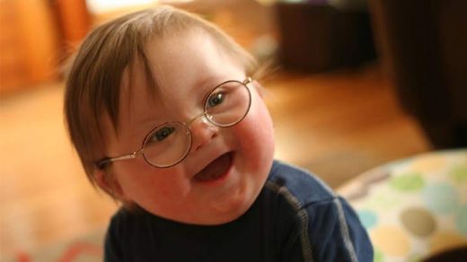 Down Sendromu 47 Kromozom