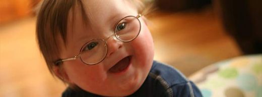 Down Sendromu Yaş Riski