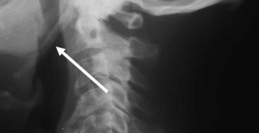 Eagle Sendromu Belirtileri ve Tedavisi