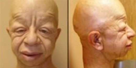 Gapo Sendromu Belirtileri ve Tedavisi