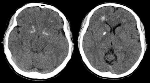 George Sendromu Nedir?
