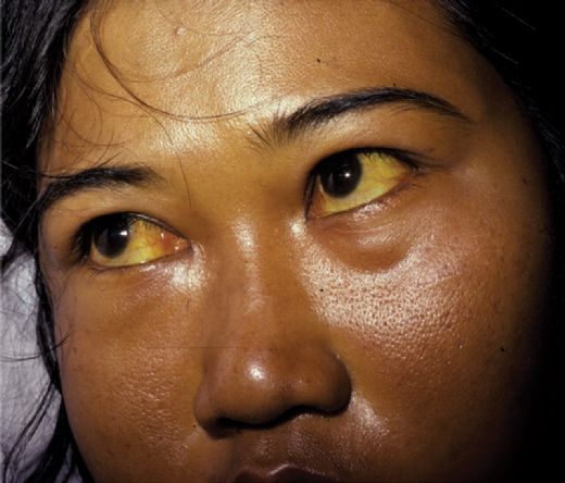 Gilbert Sendromu Belirtileri ve Tedavisi