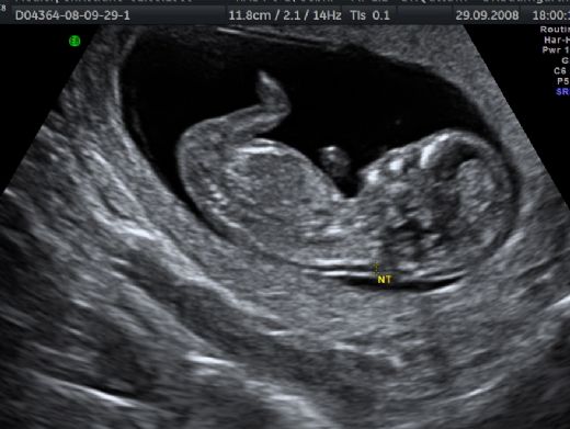 Hamilelikte Down Sendromu Belirtileri ve Tedavisi