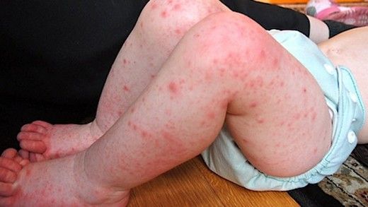 Huzursuz El Ayak Sendromu Belirtileri ve Tedavisi