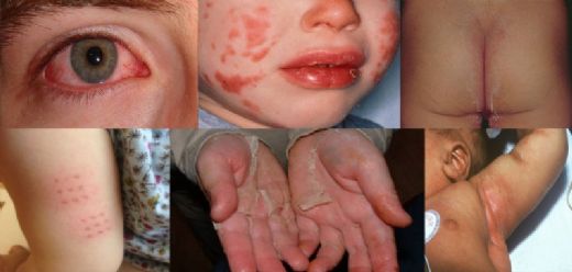 Kawasaki Sendromu Belirtileri ve Tedavisi