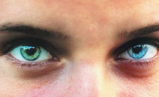 Kedi Gözü Sendromu Belirtileri ve Tedavisi