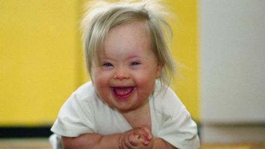 Mozaik Down Sendromu Belirtileri ve Tedavisi