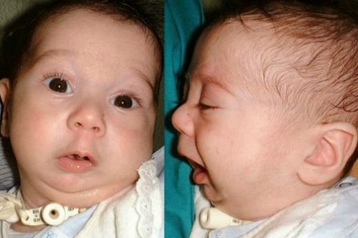 Pierre Robin Sendromu Belirtileri ve Tedavisi