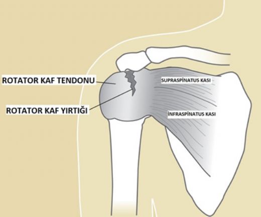 Rotator Kuf Sendromu Belirtileri ve Tedavisi