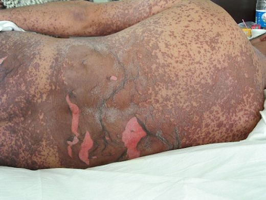 Steven Johnson Sendromu Belirtileri ve Tedavisi