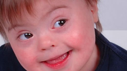 Turner Sendromu Belirtileri ve Tedavisi