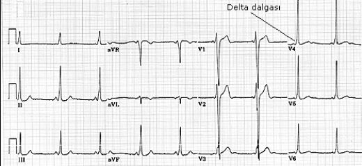 Wpw Sendromu Belirtileri ve Tedavisi