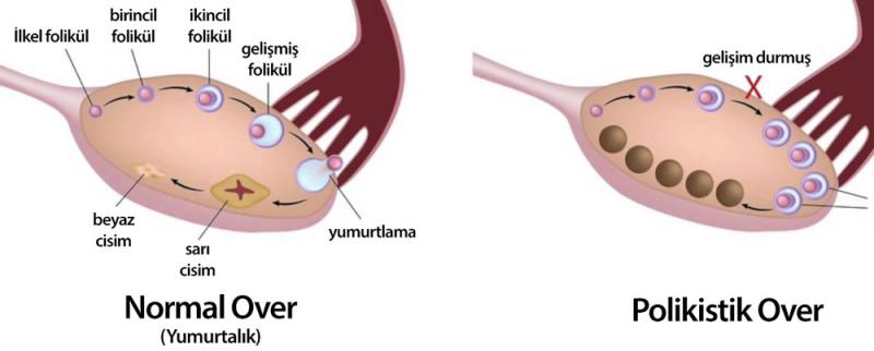 Polikistik Over Sendromu Belirtileri ve Tedavisi